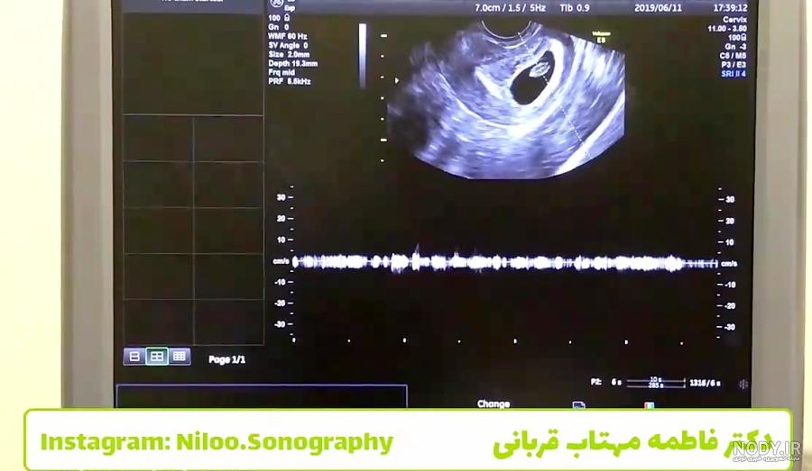 تعداد ضربان قلب در تست ورزش