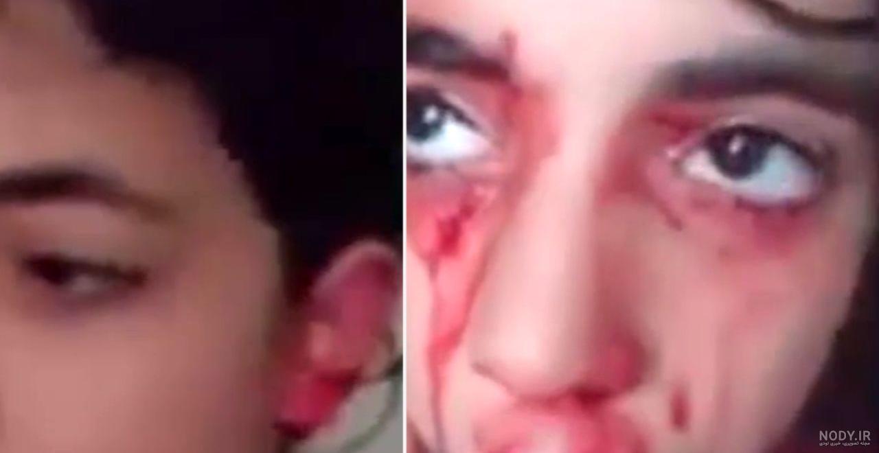 انواع قرمزی چشم انواع قرمزی چشم
