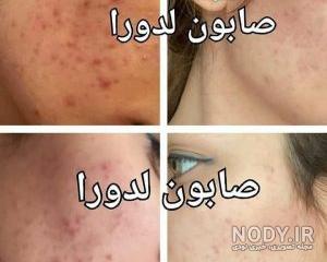 خواص مریم گلی برای جوش صورت