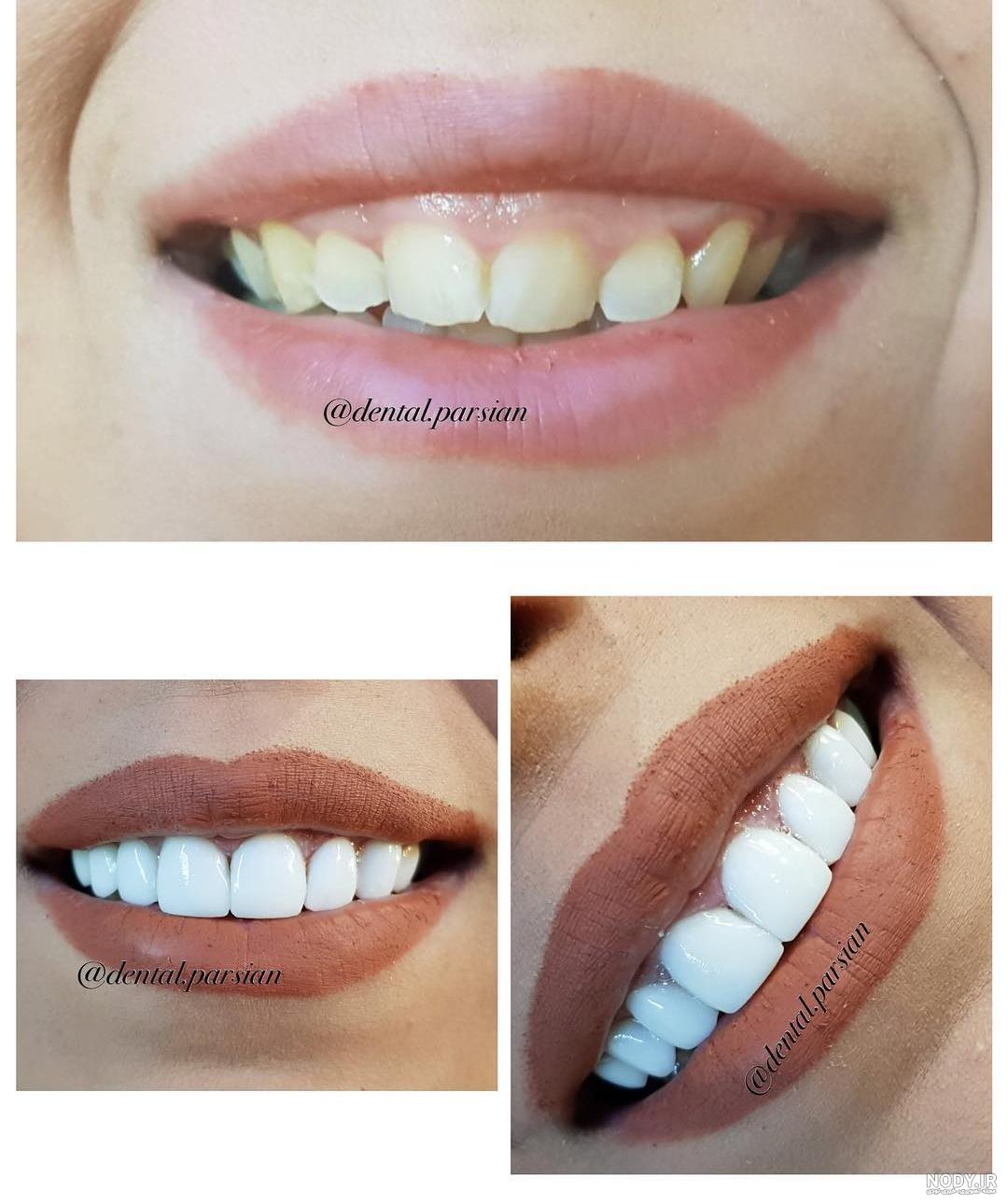 عکس لمینت دندان خرگوشی عکس لمینت دندان خرگوشی