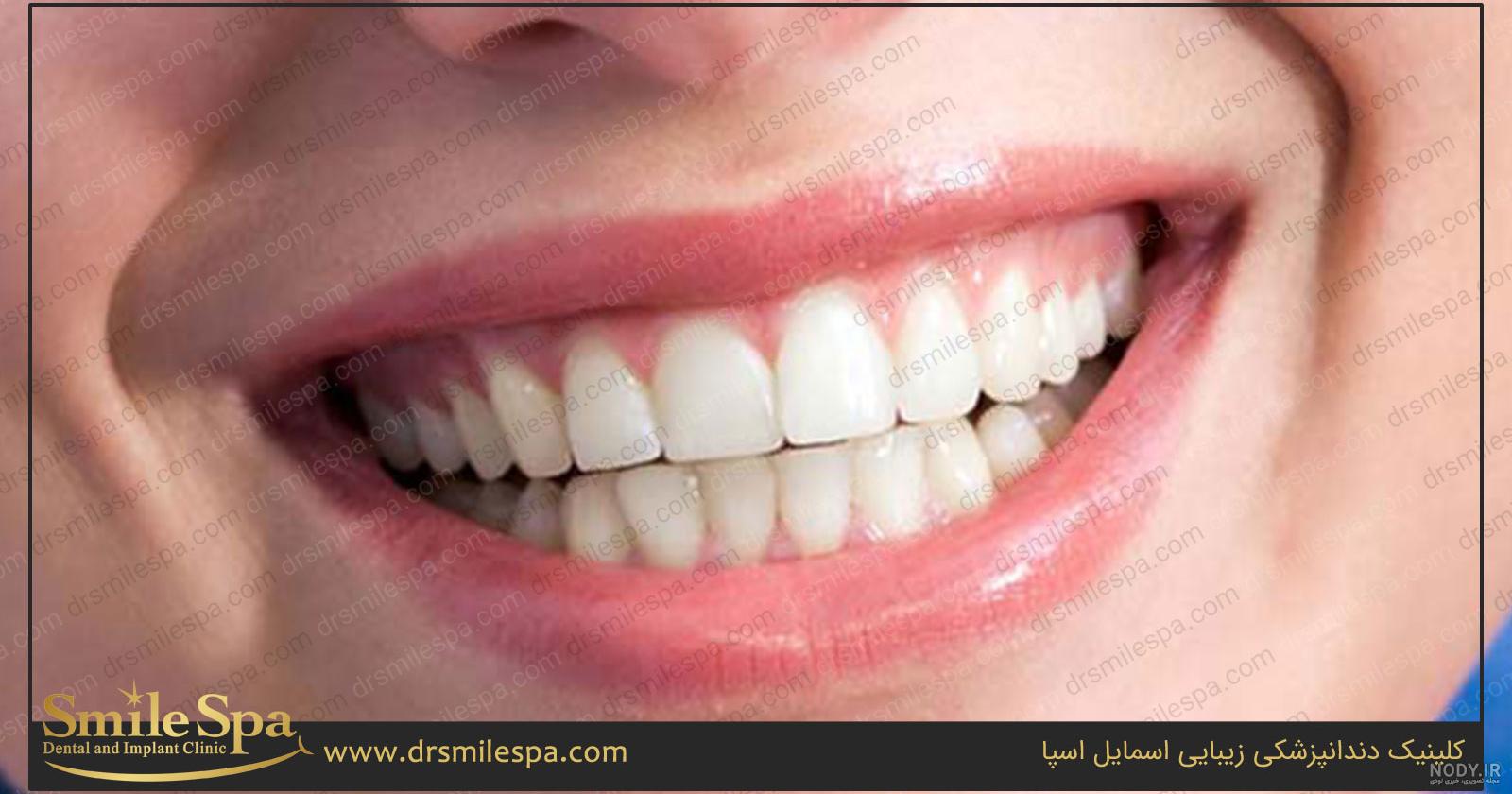 فیلم لمینت دندان فیلم لمینت دندان