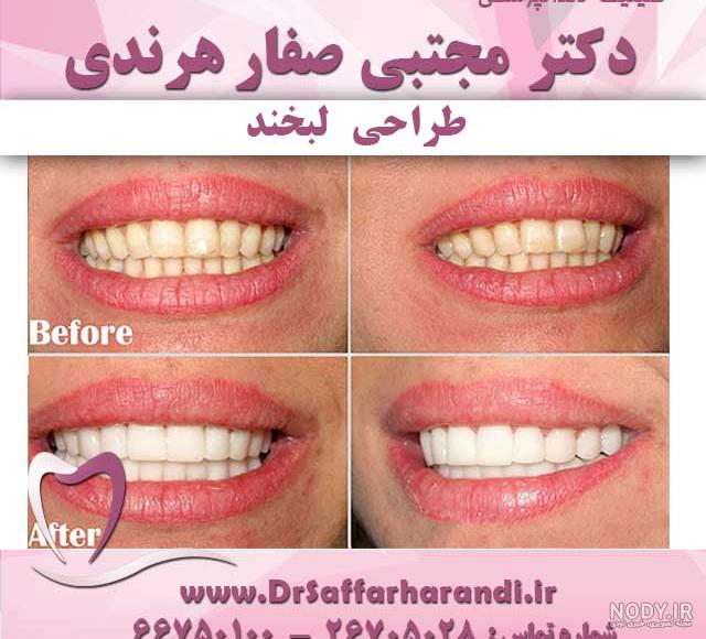 قیمت لمینت دندان قیمت لمینت دندان