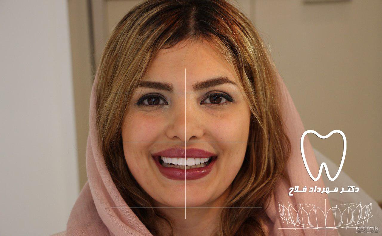 هزینه ترمیم دندان لب پر شده