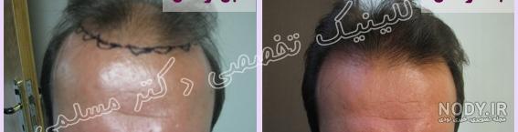ریزش مو بعد از کاشت ریزش مو بعد از کاشت
