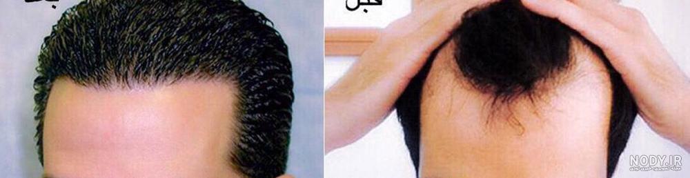 عکس علیخانی قبل کاشت مو عکس علیخانی قبل کاشت مو