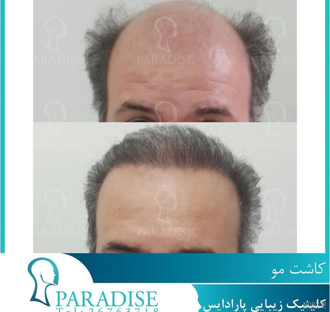عکس قبل از کاشت مو علیخانی عکس قبل از کاشت مو علیخانی