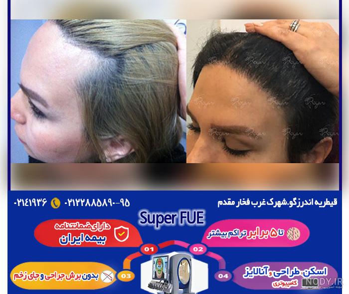 عکس قبل و بعد کاشت مو عکس قبل و بعد کاشت مو