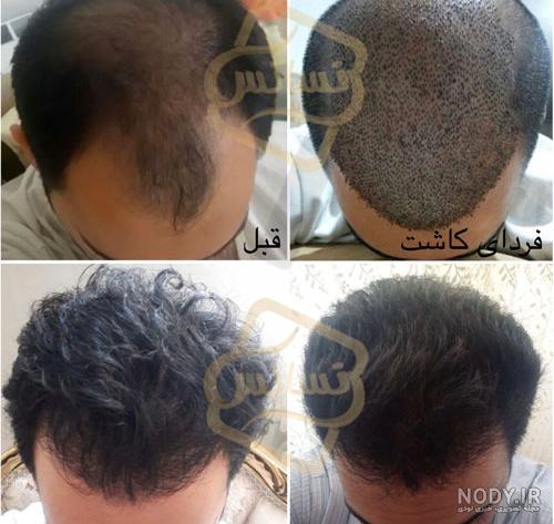 عکس قبل کاشت مو عکس قبل کاشت مو