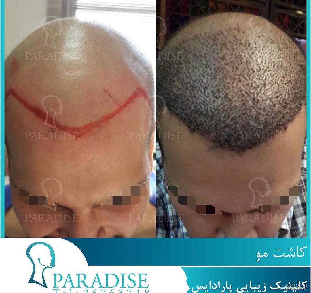 عکس کاشت مو بعد از دو ماه عکس کاشت مو بعد از دو ماه