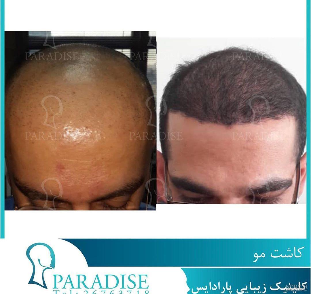 فیلم مراحل کاشت مو فیلم مراحل کاشت مو