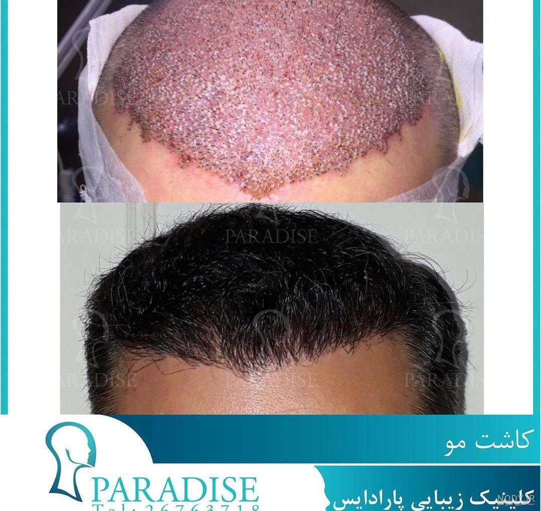 مراحل بعد از کاشت مو مراحل بعد از کاشت مو