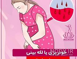 لکه بینی در بارداری نشانه پسر نی نی سایت
