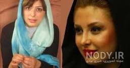 پروتز لب نیوشا ضیغمی پروتز لب نیوشا ضیغمی