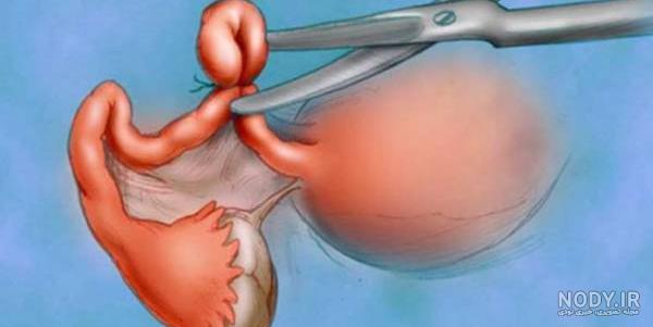 خرید اینترنتی چسب ضد بارداری خرید اینترنتی چسب ضد بارداری