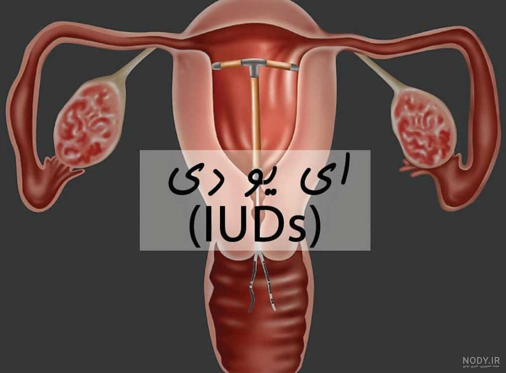 عوارض حلقه ضد بارداری عوارض حلقه ضد بارداری