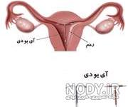 عوارض حلقه ضد بارداری عوارض حلقه ضد بارداری