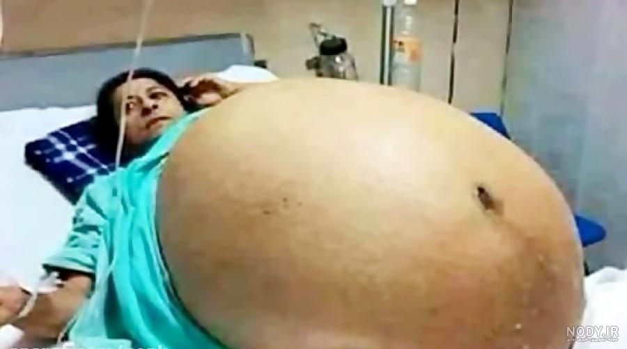 عکس جنین سه قلو در شکم مادر عکس جنین سه قلو در شکم مادر