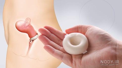 قیمت دستگاه ضد بارداری iud مسی قیمت دستگاه ضد بارداری iud مسی
