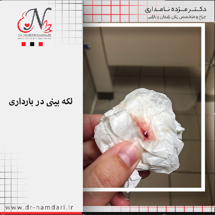کیا لکه بینی تیره داشتن و باردار بودن کیا لکه بینی تیره داشتن و باردار بودن