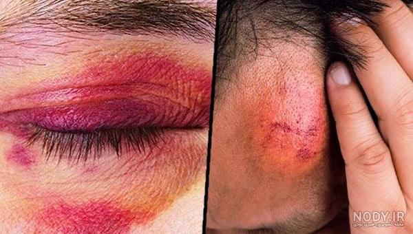 عکس کبودی های خطرناک