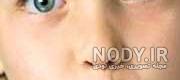 قرمزی چشم بعد از عمل استرابیسم قرمزی چشم بعد از عمل استرابیسم