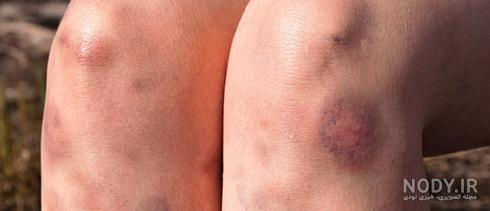 عکس کبودی پای زن
