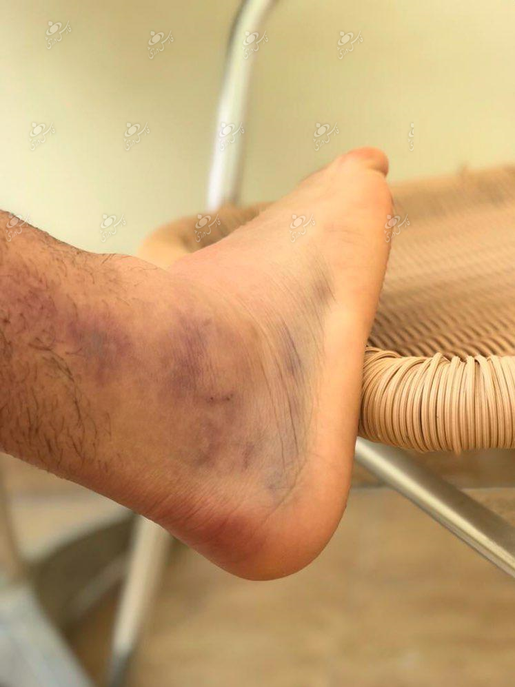 کبودی کشاله ران پا کبودی کشاله ران پا