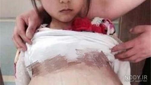عکس بارداری دختر 14 ساله