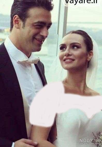 بیرجه آکالای قبل از عمل