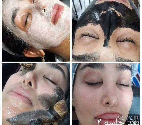 تصاویر قبل و بعد حلزون تراپی