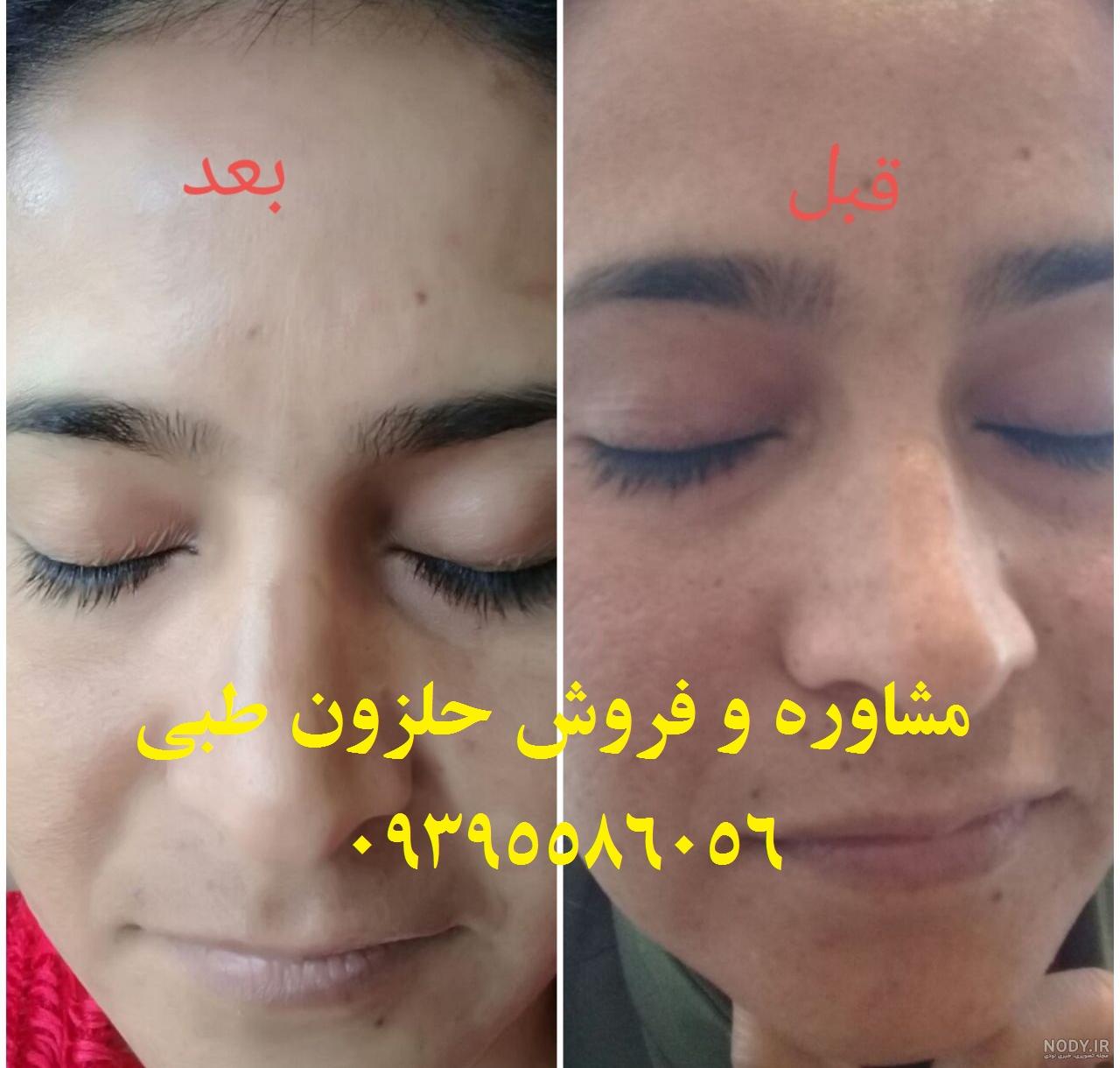تعداد جلسات حلزون تراپی