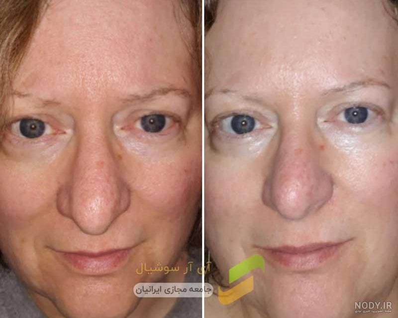 عوارض حلزون تراپی