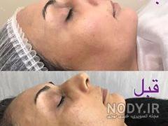 مضرات حلزون تراپی