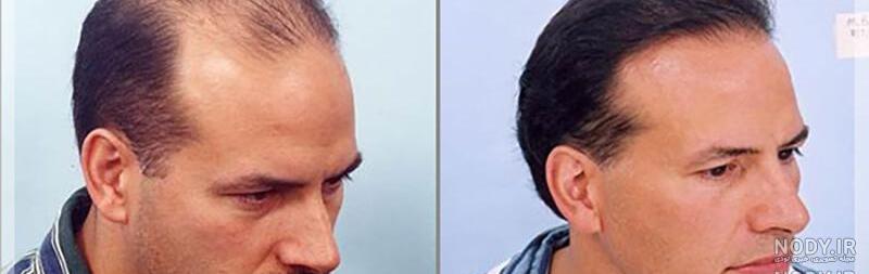 عکس احسان علیخانی قبل از کاشت مو