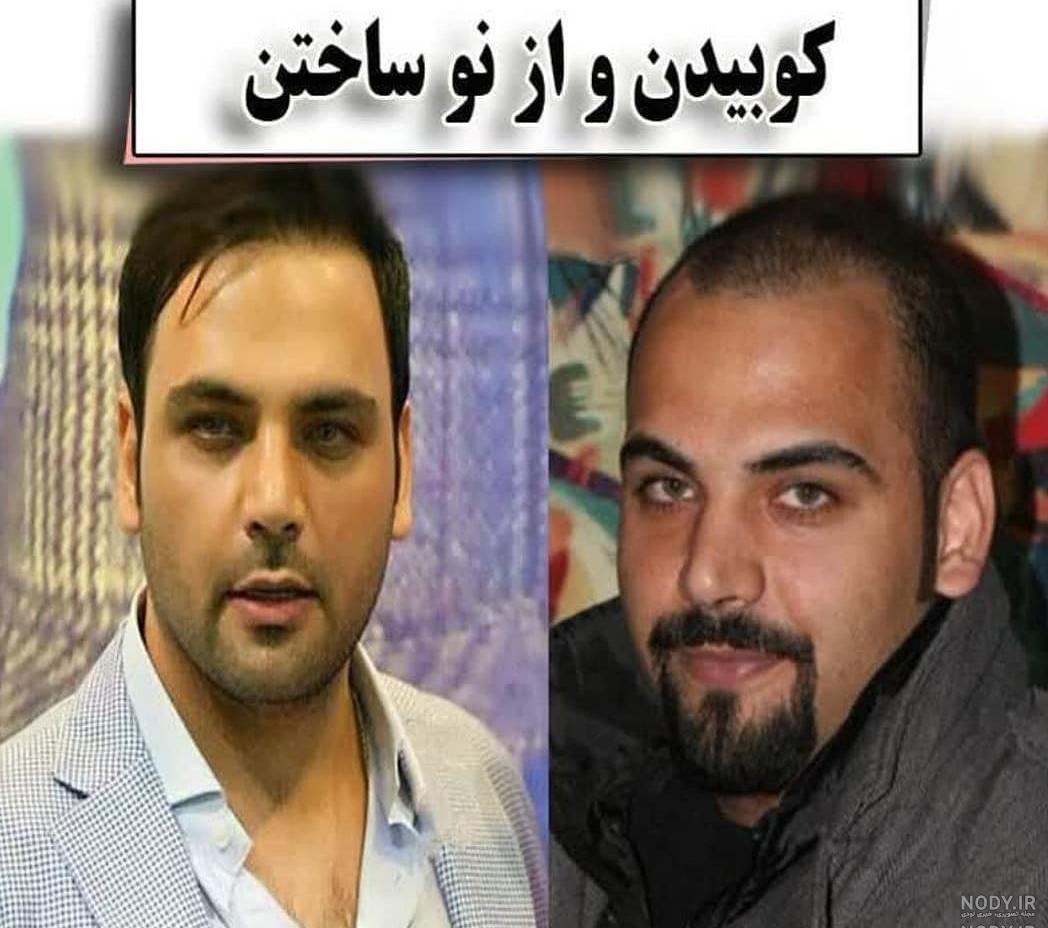 عکس احسان علیخانی قبل و بعد از کاشت مو