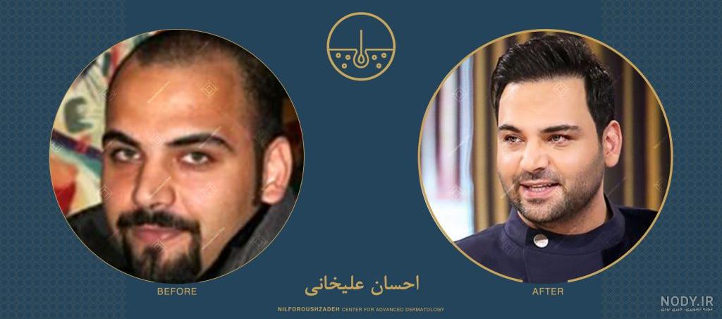 عکسهای قبل از کاشت مو احسان علیخانی