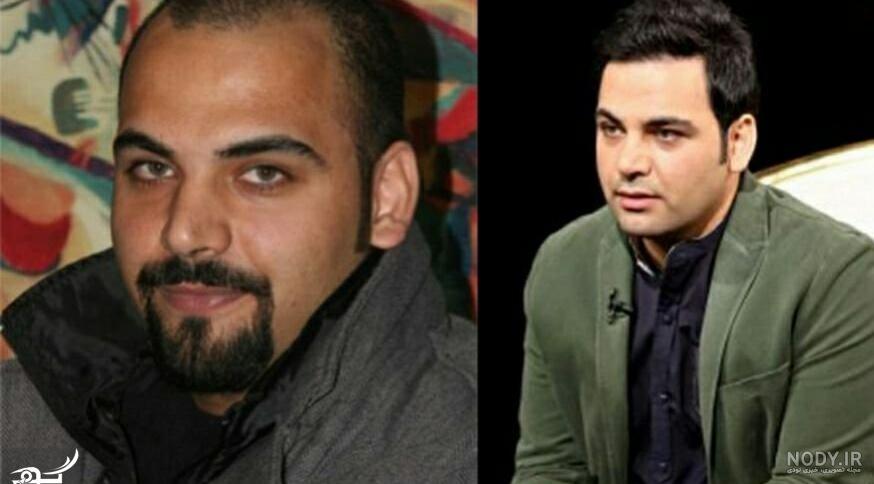 کاشت مو افراد مشهور