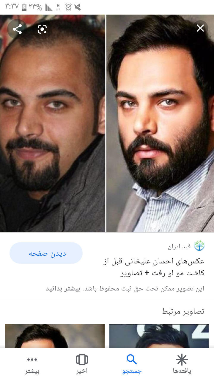 کاشت مو دیوید بکهام