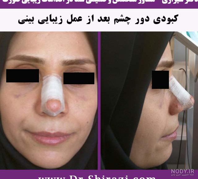 اب کرفس برای کبودی بعد عمل بینی اب کرفس برای کبودی بعد عمل بینی