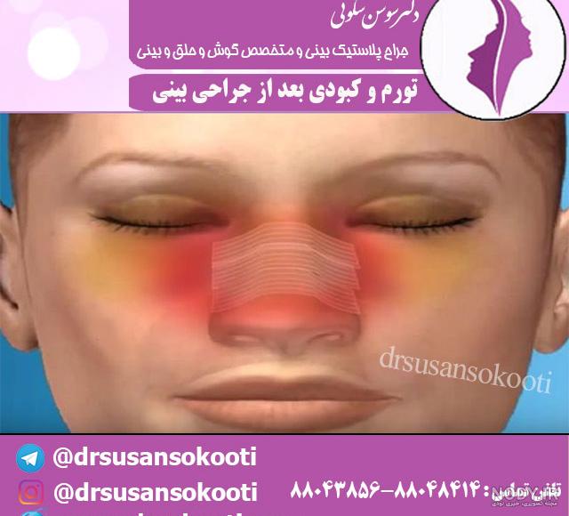 علت خونریزی چشم بعد از عمل بینی علت خونریزی چشم بعد از عمل بینی