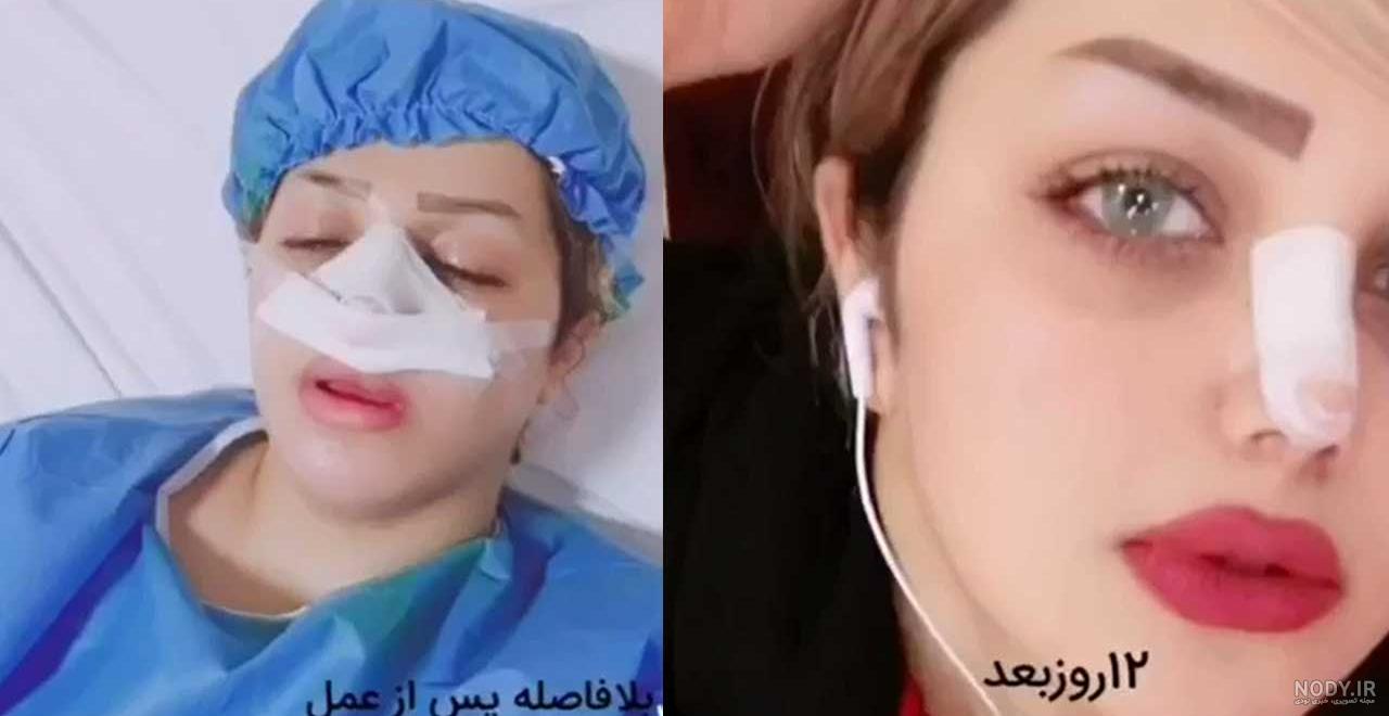 عکس کبودی بعد از عمل بینی عکس کبودی بعد از عمل بینی