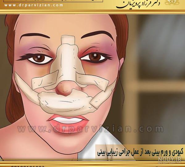 عکس کبودی بعد عمل بینی عکس کبودی بعد عمل بینی