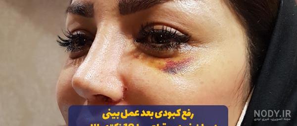 عکس کبودی عمل بینی عکس کبودی عمل بینی
