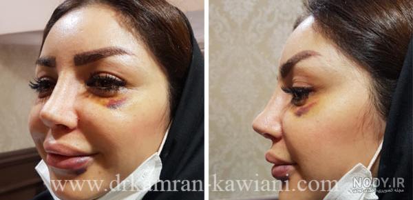 عکس کبودی چشم بعد از عمل بینی عکس کبودی چشم بعد از عمل بینی