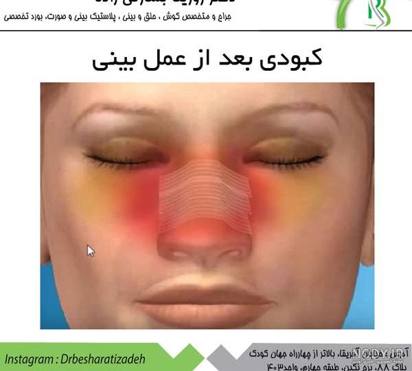 قرص برای کبودی عمل بینی قرص برای کبودی عمل بینی
