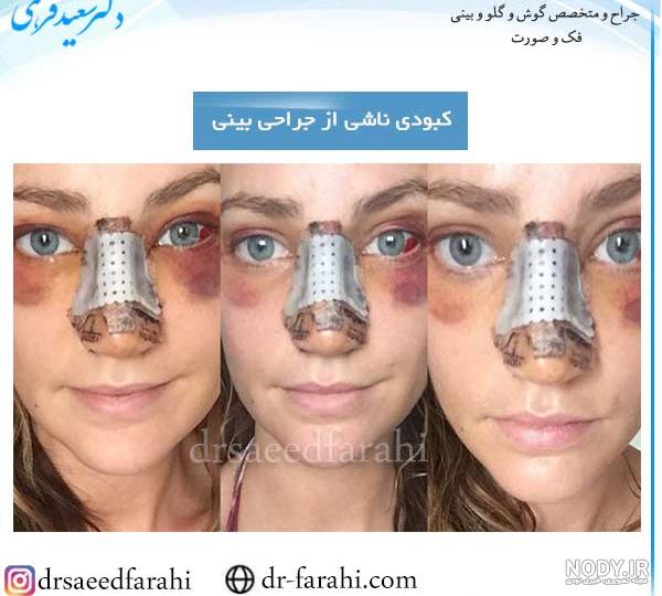 قطره تیرلوز برای قرمزی چشم قطره تیرلوز برای قرمزی چشم