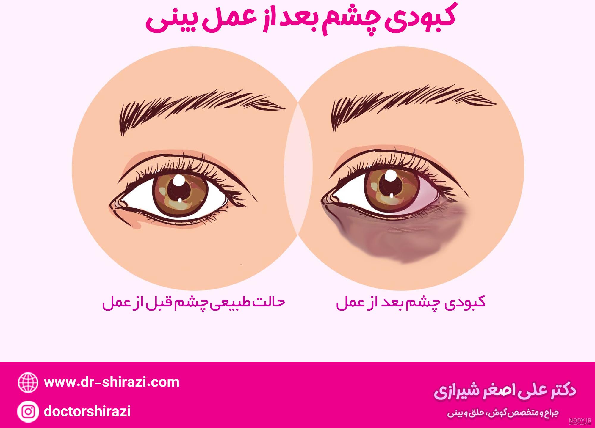 لخته خون بعد از عمل بینی لخته خون بعد از عمل بینی