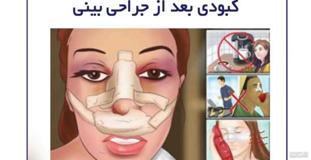 لخته خون در چشم بعد از عمل بینی نی نی سایت لخته خون در چشم بعد از عمل بینی نی نی سایت