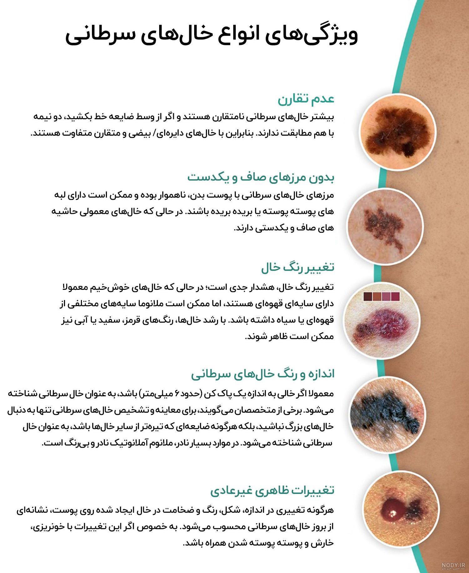 از کجا بفهمیم خال سرطانی است؟