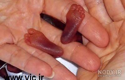 عکس نوزادی که سه چشم دارد